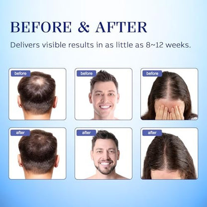 5% Minoxidil Hair Regrowth Spray for Men and Women - 2 Pack Avelisse