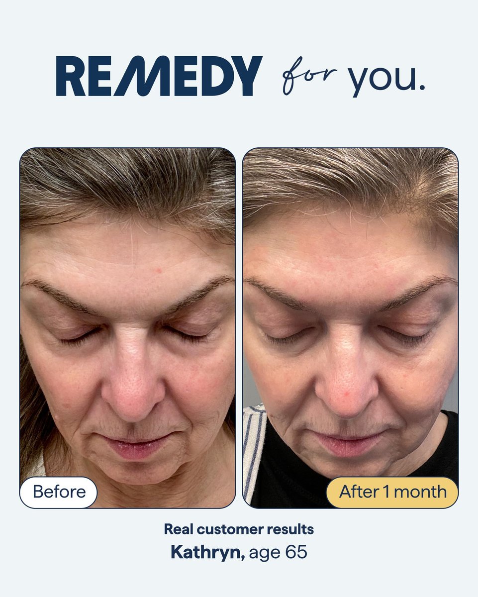 Remedy for Healthy Aging - Retinal, Resveratrol, Glycolic Acid, Argireline, Ferulic Acid, Matrixyl 3000 - Anti-Aging Serum for Wrinkles, Uneven Texture & Tone - By Dermatologist Dr. Shah (1 Fl Oz) Avelisse