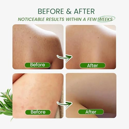 PHARMBANNER Tea Tree Antifungal Body Wash – Soothes Folliculitis, Acne, Jock Itch, Athlete's Foot, Ringworm, Tinea Versicolor, Body Odor, Eczema & Dermatitis-Prone Skin, 11.84 Fl Oz Avelisse