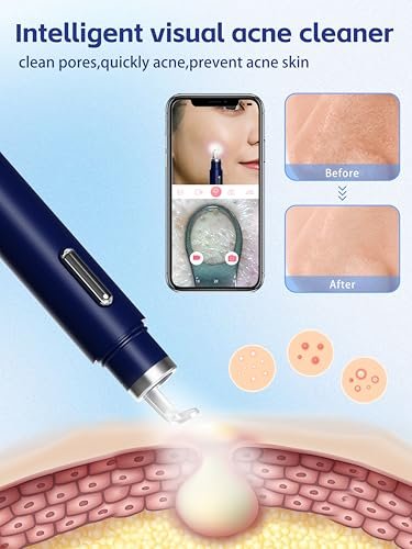 Visual Blackhead Remover Tool with Camera - 20X 1080P Pimple Popper Extractor Kit for iPhone/Android (Blue) Avelisse