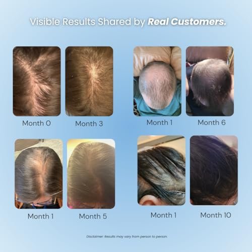 Growplex Vitafoam 5% Minoxidil Foam for Men & Women – DHT Blocking, Non-Greasy, Fast-Drying Hair Regrowth Treatment Avelisse