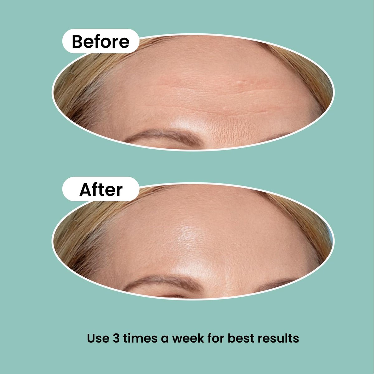 NURIVE Advanced Wrinkle Patches 20ct - Large (Forehead) | Invisible Overnight Wrinkle Tape with Retinol & Collagen for Smile Lines & Frown Lines Avelisse