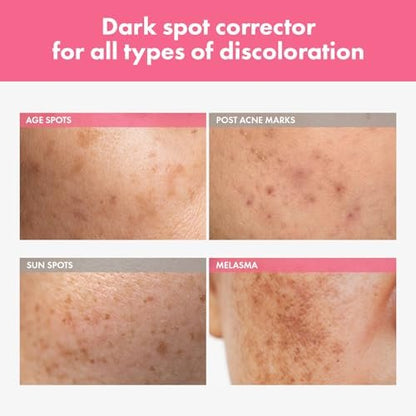 TOSOWOONG Arbutin 7% Intensive Spot Cream – Dark Spot Corrector with Tranexamic Acid & Niacinamide | Korean Skin Care 20ml