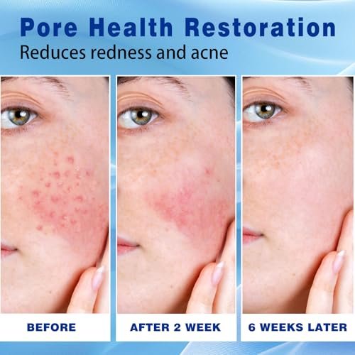 Sefralls 10% Azelaic Acid Acne Cream - Redness Relief & Clarifying Face Moisturizer for Acne-Prone Skin, 1 oz - görsel 10