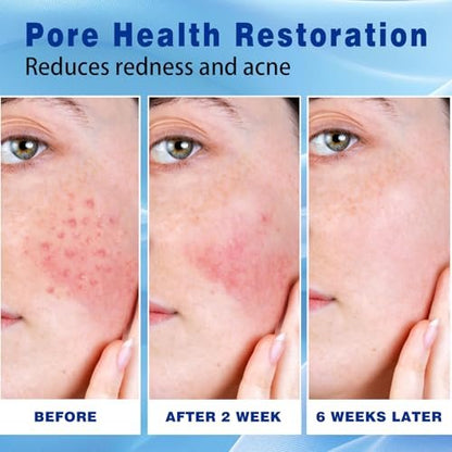 Sefralls 10% Azelaic Acid Acne Cream - Redness Relief & Clarifying Face Moisturizer for Acne-Prone Skin, 1 oz