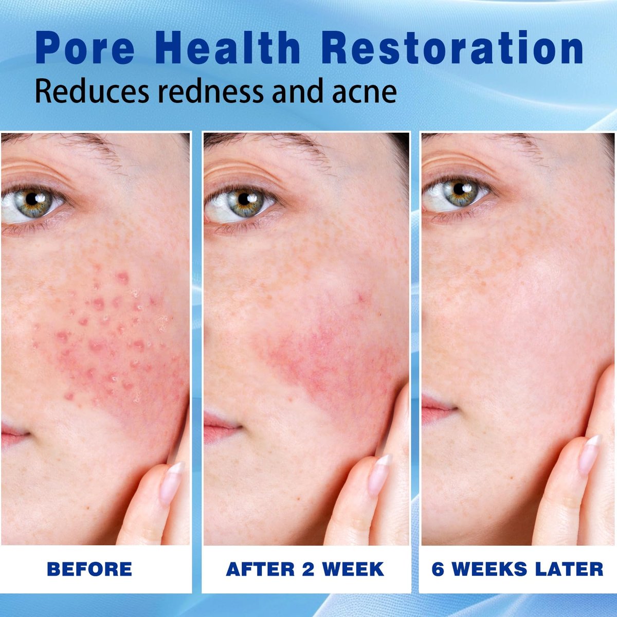 Sefralls 10% Azelaic Acid Acne Cream - Redness Relief & Clarifying Face Moisturizer for Acne-Prone Skin, 1 oz - görsel 9