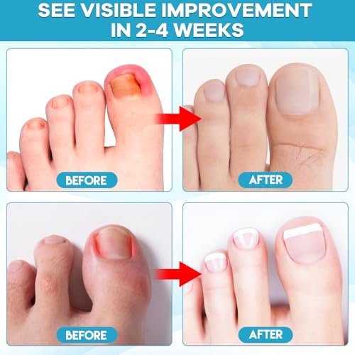 Ingrown Toenail Drop - Effective Pain Reliever and Softener Kit for Men and Women, Ingrown Toenail Corrector Drops, 1 Fl Oz Avelisse