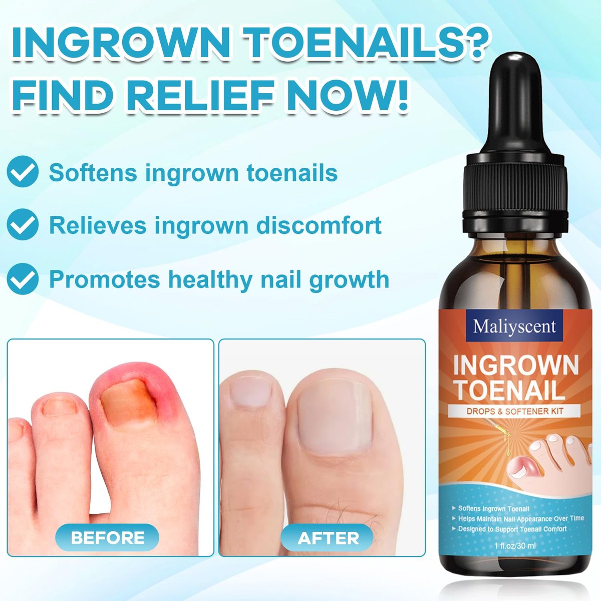 Ingrown Toenail Drop - Effective Pain Reliever and Softener Kit for Men and Women, Ingrown Toenail Corrector Drops, 1 Fl Oz Avelisse