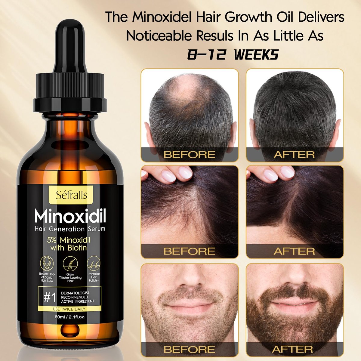 5% Minoxidil Hair Growth Oil for Men & Women Kit - Extra Strength Regrowth Serum, Topical Hair Loss Treatment, Thicker Healthier Hair & Beard Growth Kit, 2.11 fl.oz Avelisse