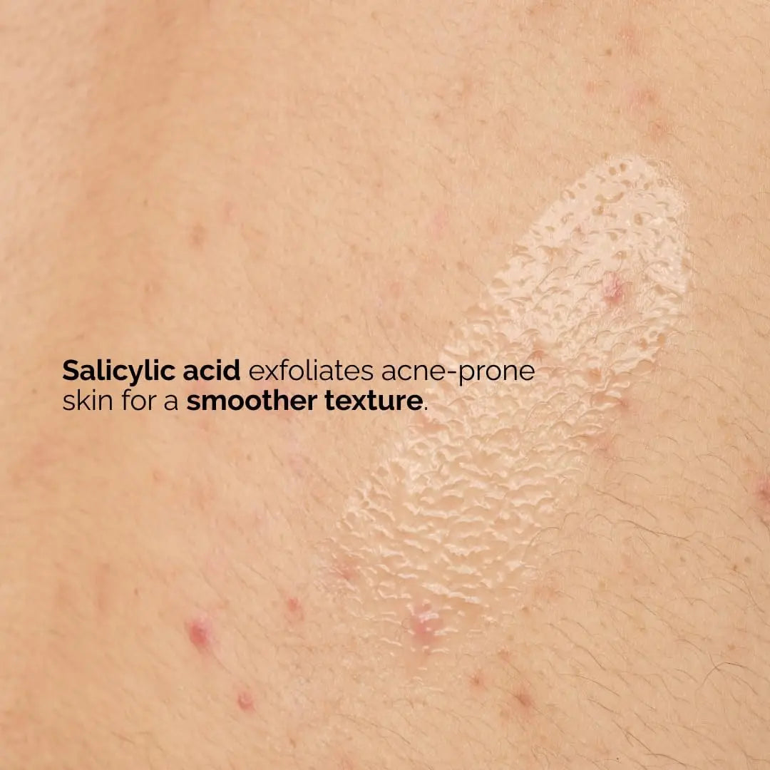 The Ordinary Salicylic Acid 0.5% Body Serum - Exfoliating Treatment for Acne-Prone Skin, 8.1 Fl Oz Avelisse