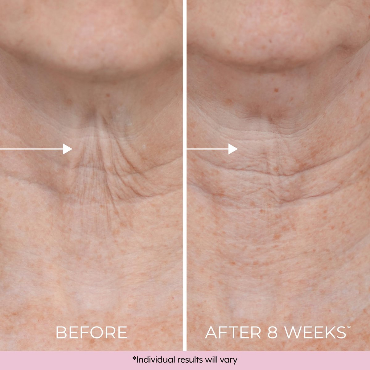 DEKLIDERM Neck Firming Cream – Anti Aging Retinol Cream for Neck Wrinkles and Sagging – Restore Firmness with Retinol & Moisturizers Avelisse