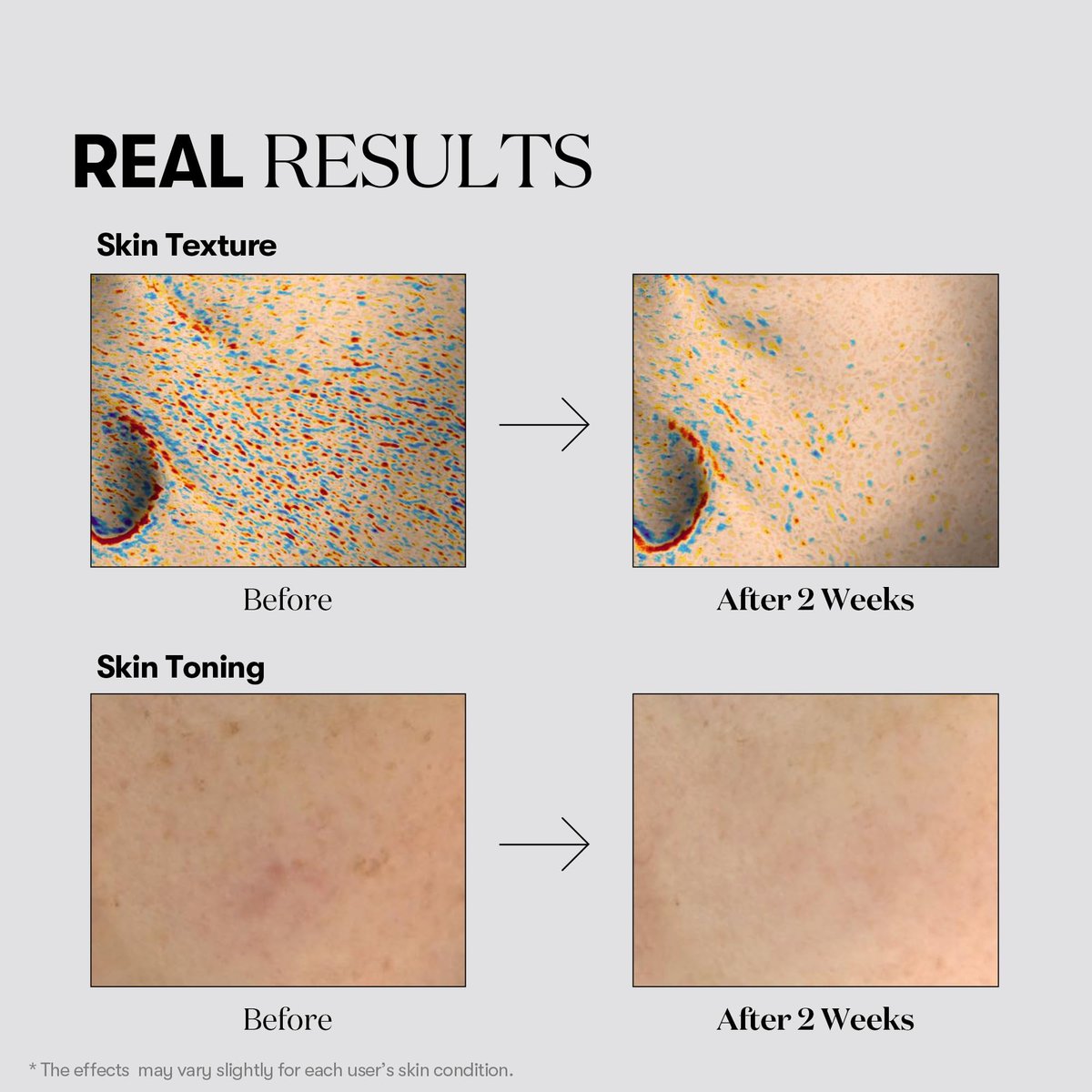 VT COSMETICS TX Toning Essence 1000 Shot - Tranexamic Acid Serum with Niacinamide & Glutathione for Radiant Glass Skin, Dark Spots, Sun Spots, Age Spots, Acne Scars - Korean Skin Care (1.01 fl. oz.) Avelisse