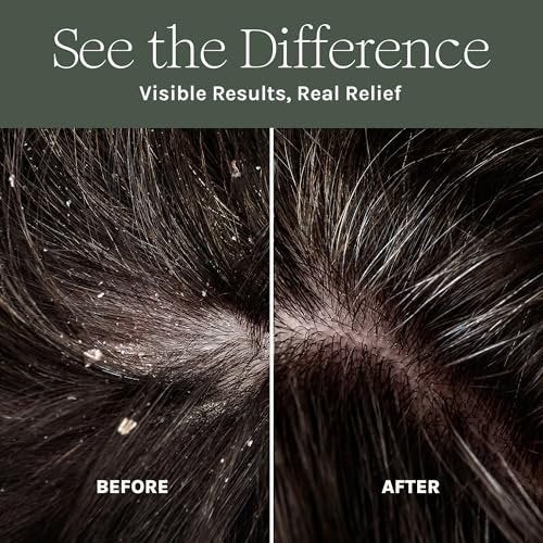 Purist Dandruff Spray – Leave-In Itchy, Dry Scalp Treatment – Hydrating, Lightweight, Soothing Scalp Moisturizer – Non-Greasy Quick Relief for Dandruff, Flaky Scalp Avelisse