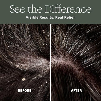 Purist Dandruff Spray – Leave-In Itchy, Dry Scalp Treatment – Hydrating, Lightweight, Soothing Scalp Moisturizer – Non-Greasy Quick Relief for Dandruff, Flaky Scalp Avelisse