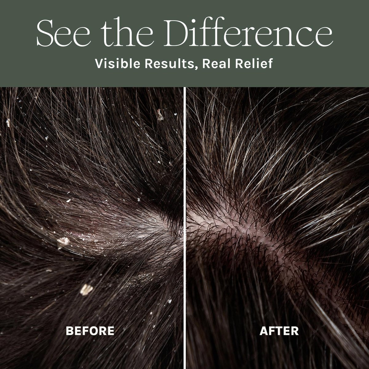 Purist Dandruff Spray – Leave-In Itchy, Dry Scalp Treatment – Hydrating, Lightweight, Soothing Scalp Moisturizer – Non-Greasy Quick Relief for Dandruff, Flaky Scalp Avelisse