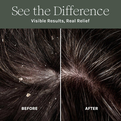 Purist Dandruff Spray – Leave-In Itchy, Dry Scalp Treatment – Hydrating, Lightweight, Soothing Scalp Moisturizer – Non-Greasy Quick Relief for Dandruff, Flaky Scalp Avelisse