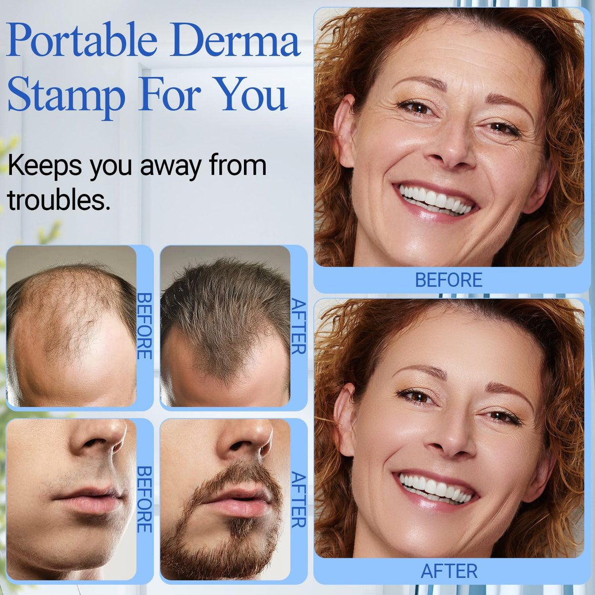 ANSIOVON Derma Stamp - Microneedling Stamp for Hair, Face, Scalp, Beard - At-Home Micro Needle Dermastamp for Women and Men - görsel 9