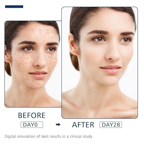 Dark Spot Remover for Face and Body - Advanced Corrector Serum for Melasma, Age Spots, Freckles & Sun Spots with 360° Roller - 0.67 fl oz - görsel 10