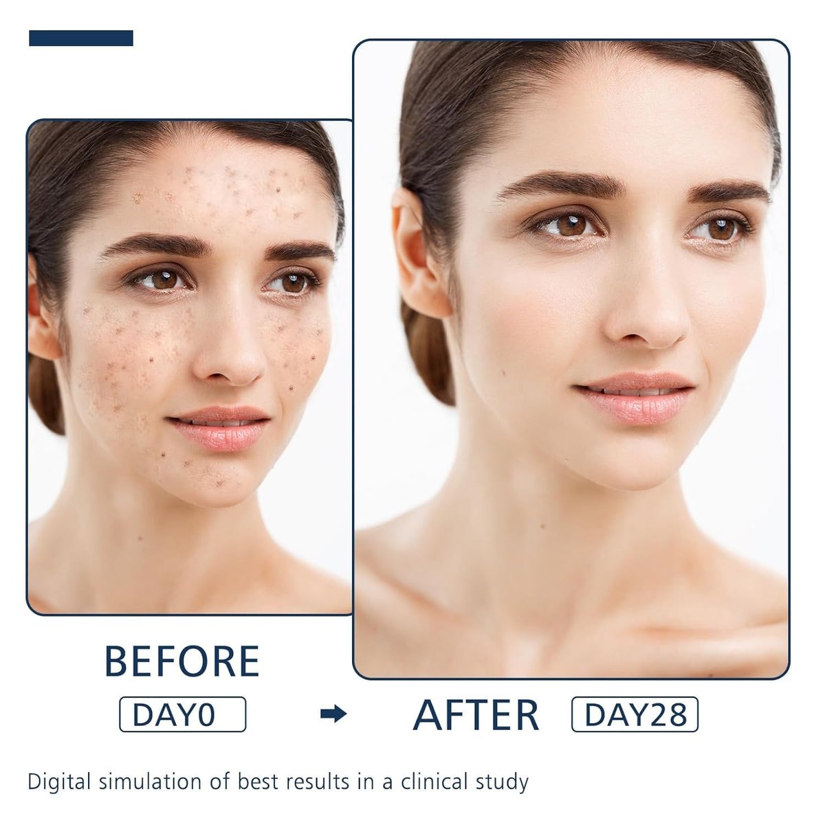 Dark Spot Remover for Face and Body - Advanced Corrector Serum for Melasma, Age Spots, Freckles & Sun Spots with 360° Roller - 0.67 fl oz - görsel 9