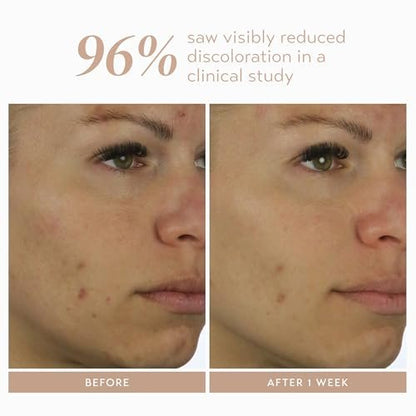 Shani Darden Rescue Serum with 10% Azelaic Complex – Lightweight Hydrating Azelaic Acid Serum for Redness & Acne, Vegan, 1 fl oz Avelisse