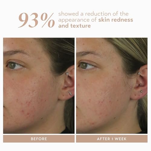 Shani Darden Rescue Serum with 10% Azelaic Complex – Lightweight Hydrating Azelaic Acid Serum for Redness & Acne, Vegan, 1 fl oz Avelisse
