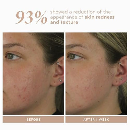 Shani Darden Rescue Serum with 10% Azelaic Complex – Lightweight Hydrating Azelaic Acid Serum for Redness & Acne, Vegan, 1 fl oz Avelisse