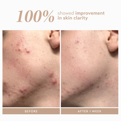 Shani Darden Rescue Serum with 10% Azelaic Complex – Lightweight Hydrating Azelaic Acid Serum for Redness & Acne, Vegan, 1 fl oz Avelisse