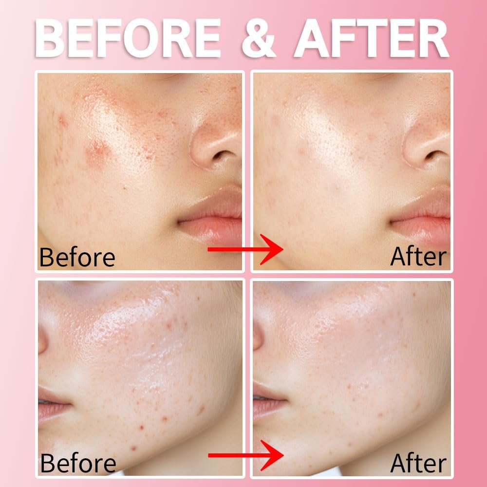 Purederm Blemish Spot Treatment Gel with Salicylic Acid 2% – Soothing Acne Care for Irritated Skin, Day & Night Use, 20ml - görsel 7