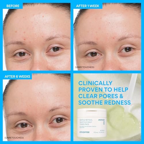 innisfree Daily Gentle Retinol Salicylic Toner Pads for Acne-Prone Skin | Korean Sheet Mask Pads (70 Count) Avelisse