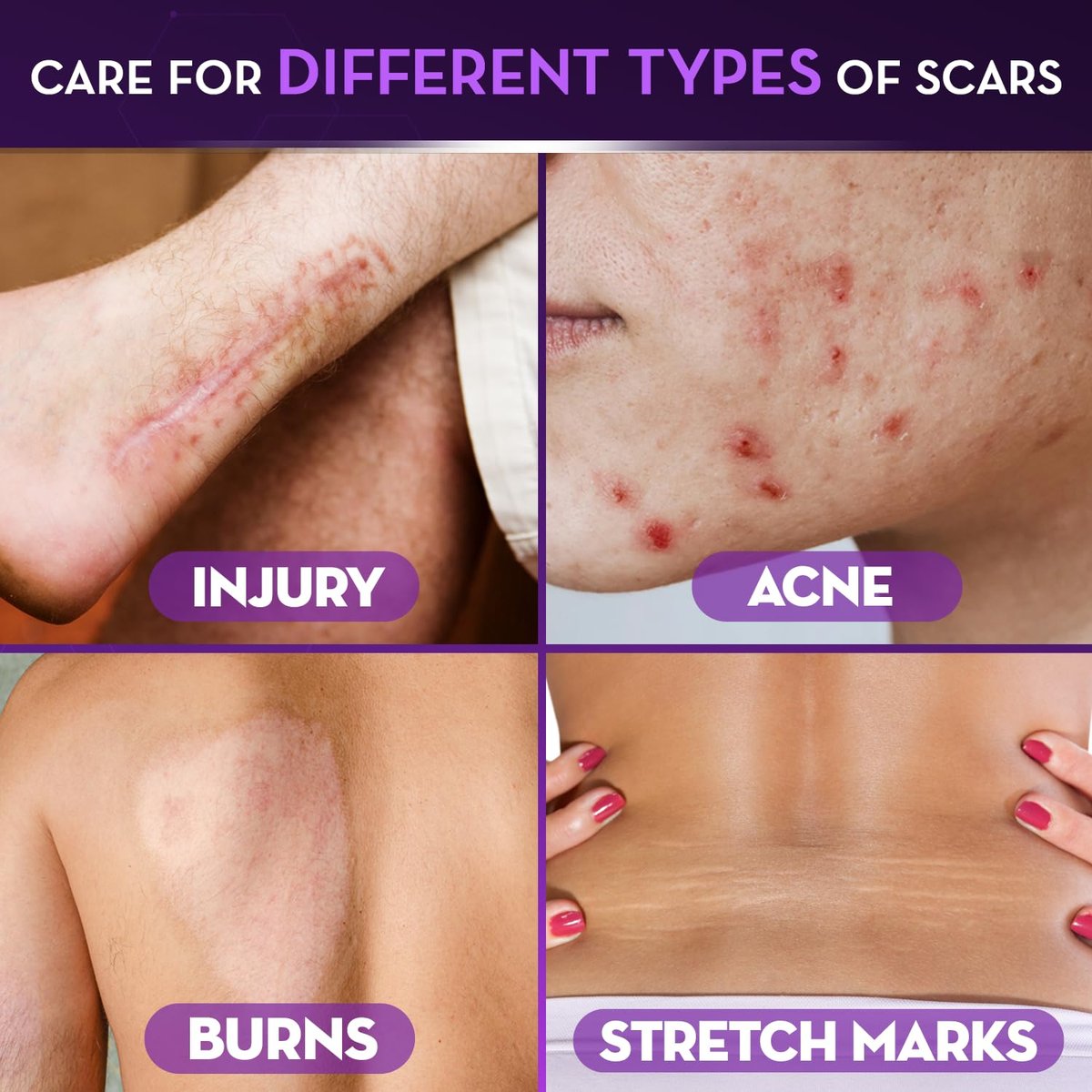 Cicatricure Advanced Scar Gel for Face & Body – Proven Results in 2 Weeks, Scar Treatment for Surgical Scars, Stretch Marks, Burns, Injuries & Acne Scars, 2 oz (56g) Avelisse