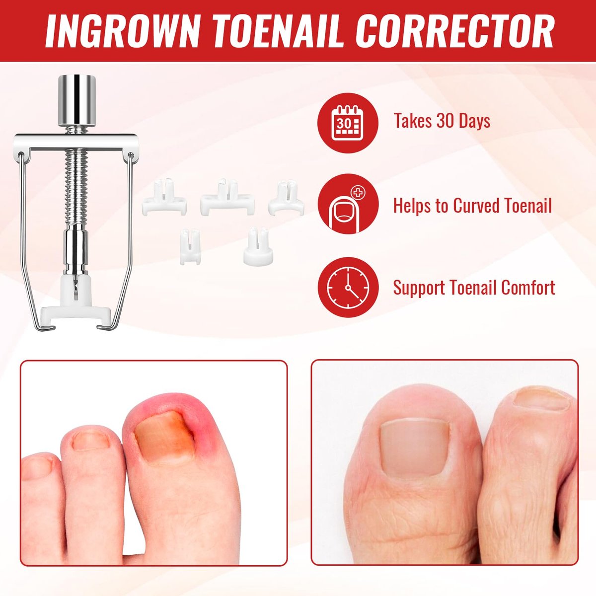 Ingrown Toenail Removal Kit – Complete Tool Set with Corrector, Drops, Patches, Clipper & File | YEQOIZ Avelisse