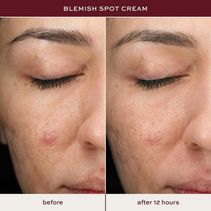 ITK Skincare Salicylic Acid Acne Spot Treatment - Fast Active Acne Relief for Face, Back & Body with Tea Tree Oil - 0.5oz