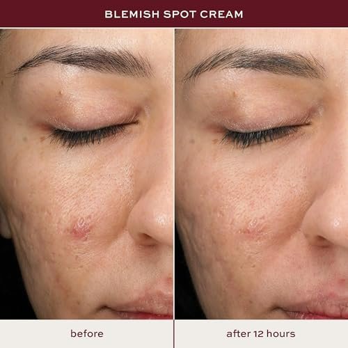 ITK Skincare Salicylic Acid Acne Spot Treatment - Fast Active Acne Relief for Face, Back & Body with Tea Tree Oil - 0.5oz - görsel 6