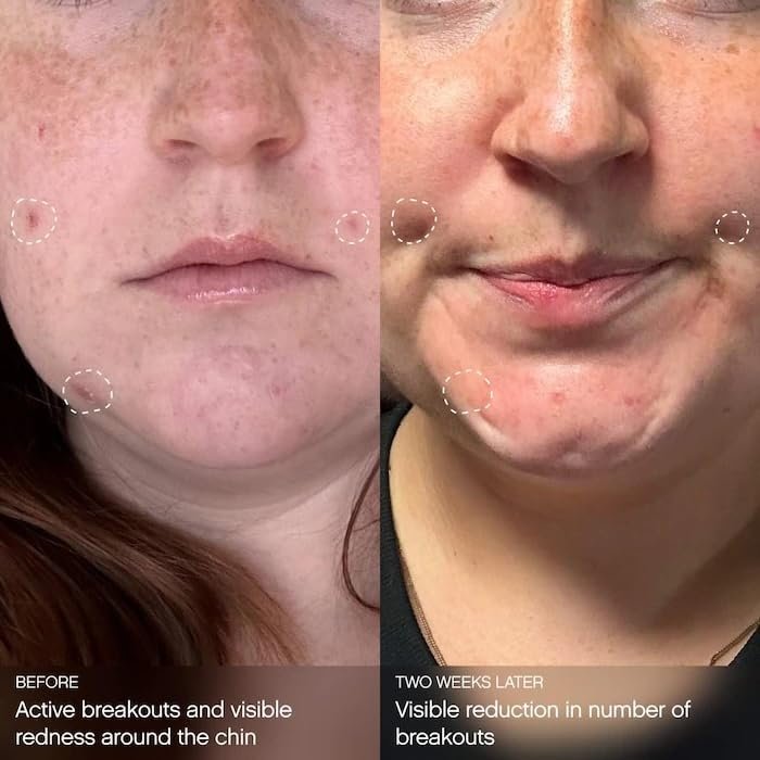 Topicals Clearly Breakout Clarifying + Calming Mask for Acne-Prone Skin | Reduces Breakouts & Redness | Clinical-Strength Dual-Acid Formula with Hypochlorous Acid | Vegan, Cruelty-Free (2 oz) Avelisse
