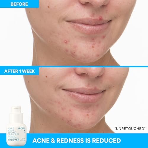 innisfree Gentle Retinol Salicylic Acne Serum - Korean Face Treatment for Blemishes & Clear Skin, 1.01 Fl Oz Avelisse