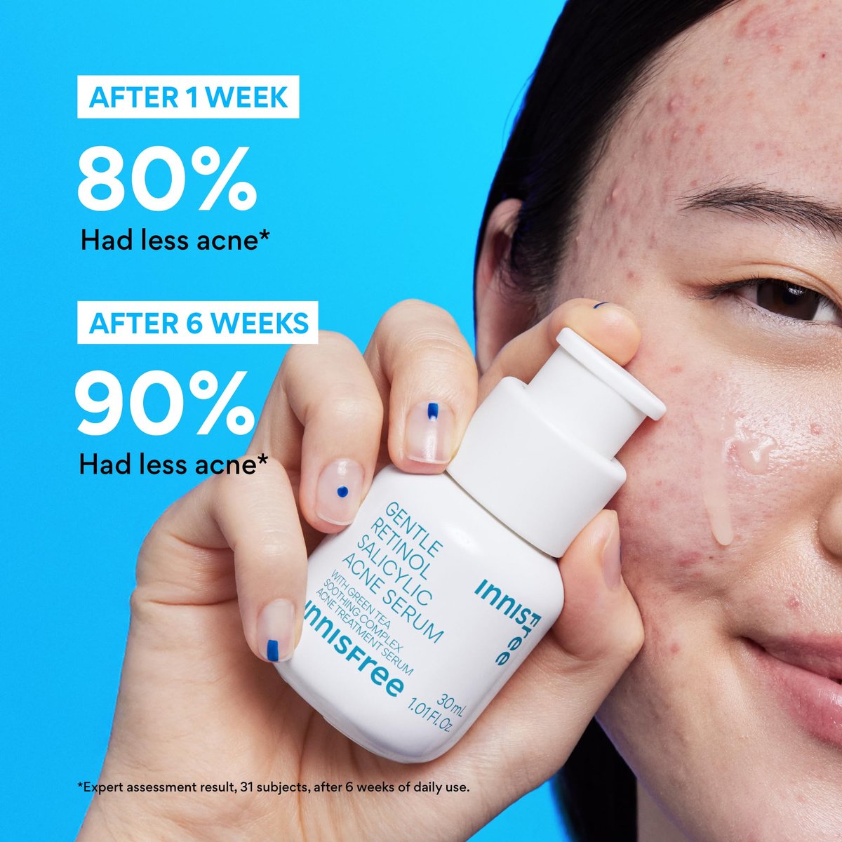 innisfree Gentle Retinol Salicylic Acne Serum - Korean Face Treatment for Blemishes & Clear Skin, 1.01 Fl Oz Avelisse