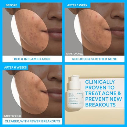 innisfree Gentle Retinol Salicylic Acne Serum - Korean Face Treatment for Blemishes & Clear Skin, 1.01 Fl Oz Avelisse