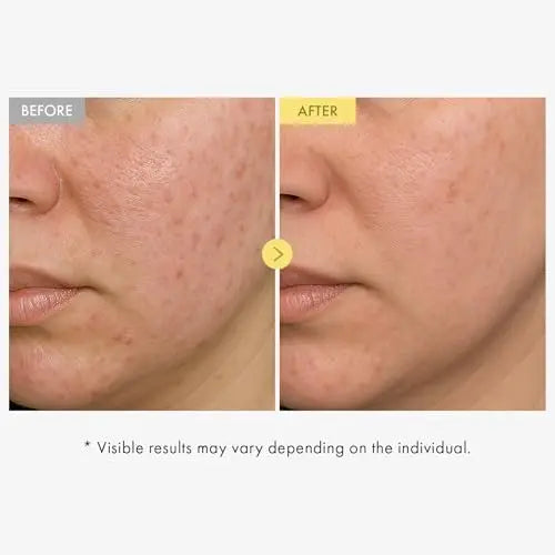TOSOWOONG Honey Glow 65% Propolis Serum with Hyaluronic Acid, Kojic Acid, Niacinamide – Hydrating & Soothing Facial Serum for Uneven Skin Tone, Glass Skin, Korean Skincare, 33ml Avelisse