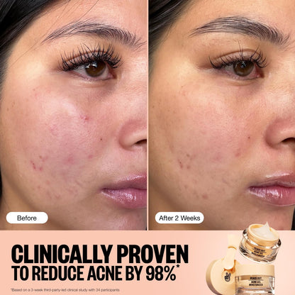 PEACE OUT Acne Gel Moisturizer for Oily Skin - 2% Salicylic Acid, Niacinamide & Ceramides, 1.69 oz Avelisse