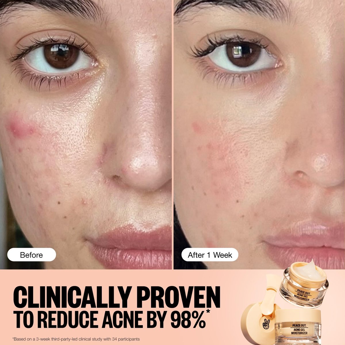 PEACE OUT Acne Gel Moisturizer for Oily Skin - 2% Salicylic Acid, Niacinamide & Ceramides, 1.69 oz Avelisse
