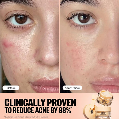 PEACE OUT Acne Gel Moisturizer for Oily Skin - 2% Salicylic Acid, Niacinamide & Ceramides, 1.69 oz Avelisse