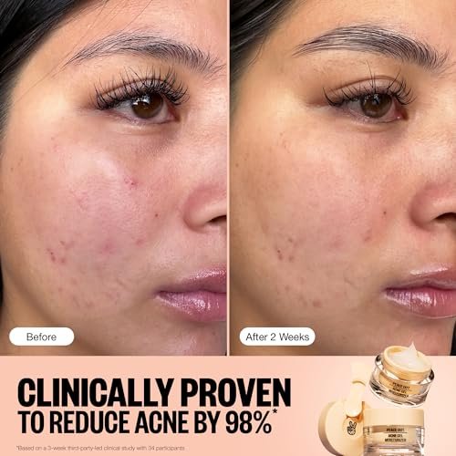 PEACE OUT Acne Gel Moisturizer for Oily Skin - 2% Salicylic Acid, Niacinamide & Ceramides, 1.69 oz Avelisse
