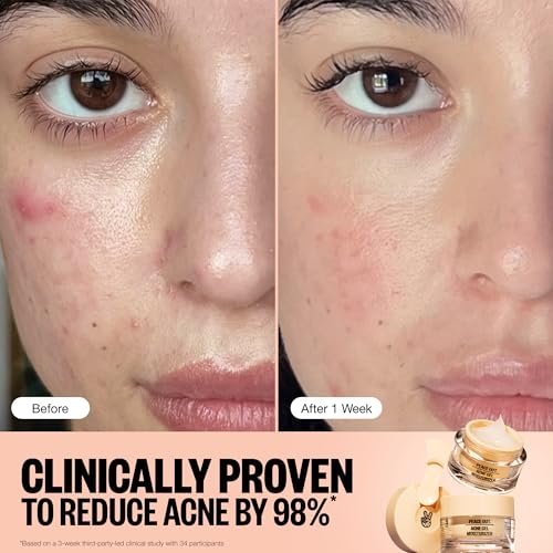 PEACE OUT Acne Gel Moisturizer for Oily Skin - 2% Salicylic Acid, Niacinamide & Ceramides, 1.69 oz Avelisse