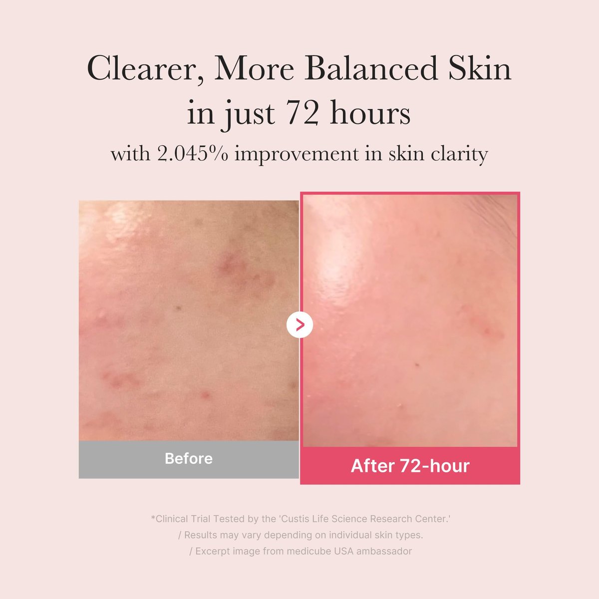Medicube TXA+Niacinamide 15% Glow Facial Serum for After Spot Care | All-in-One Daily Korean Skincare | Uneven Skin Tone, Texture, and Hydration Care | High-Potency Tranexamic Acid 5% | 1.01 fl.oz Avelisse