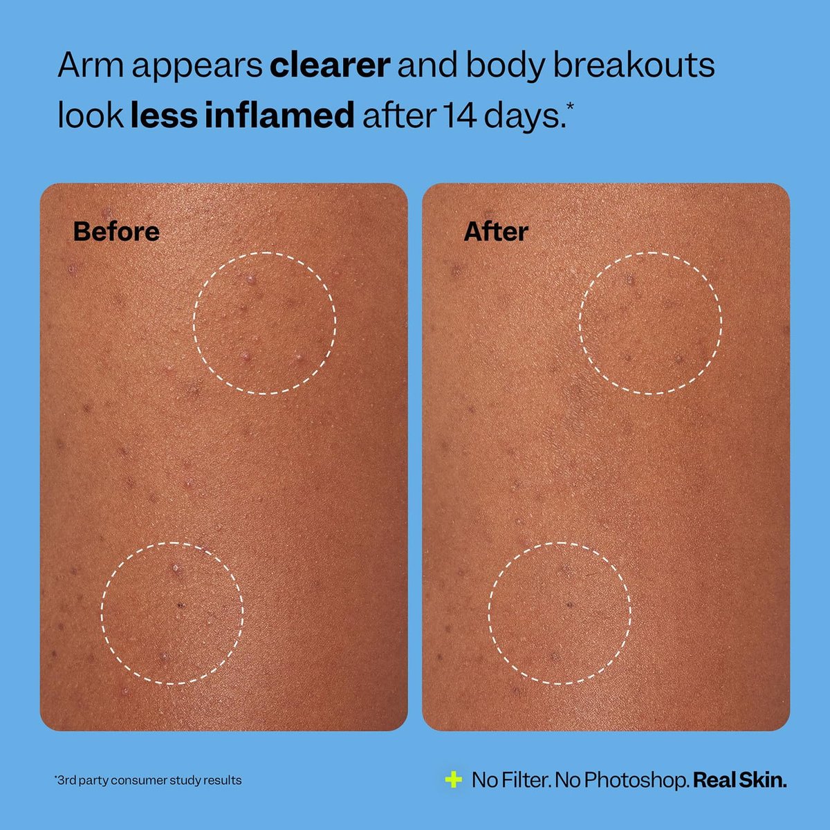 Peach Slices Body Breakout Patches (6 ct) - Overnight Body Pimple Patches - Hypoallergenic Cica & Hydrocolloid Bandages - Vegan & Cruelty Free Korean Skin Care - görsel 11