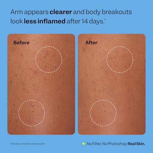 Peach Slices Body Breakout Patches (6 ct) - Overnight Body Pimple Patches - Hypoallergenic Cica & Hydrocolloid Bandages - Vegan & Cruelty Free Korean Skin Care - görsel 12