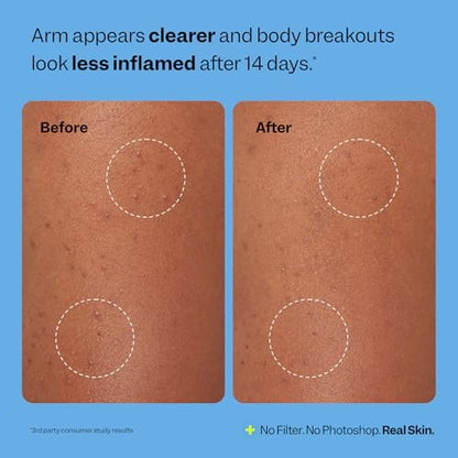 Peach Slices Body Breakout Patches (6 ct) - Overnight Body Pimple Patches - Hypoallergenic Cica & Hydrocolloid Bandages - Vegan & Cruelty Free Korean Skin Care
