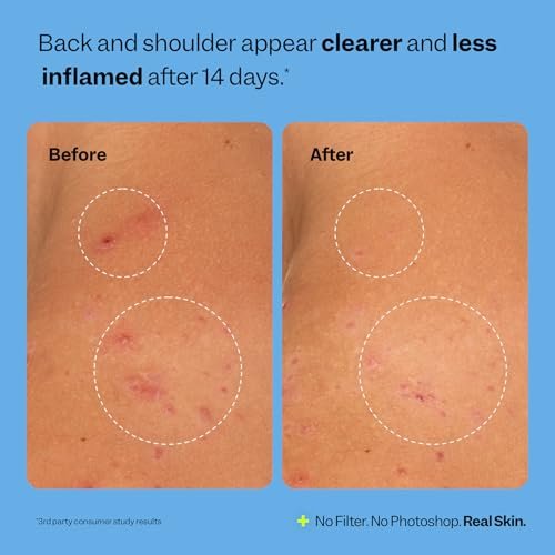Peach Slices Breakout Banisher Body Spray - Salicylic Acid & Glycolic Acid Body Treatment for Clear Skin, 4 oz Avelisse