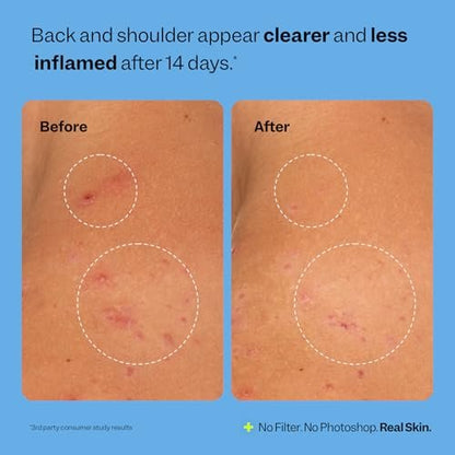 Peach Slices Breakout Banisher Body Spray - Salicylic Acid & Glycolic Acid Body Treatment for Clear Skin, 4 oz Avelisse