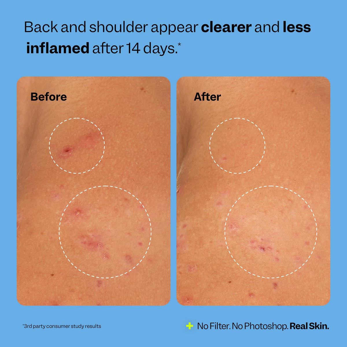 Peach Slices Breakout Banisher Body Spray - Salicylic Acid & Glycolic Acid Body Treatment for Clear Skin, 4 oz Avelisse